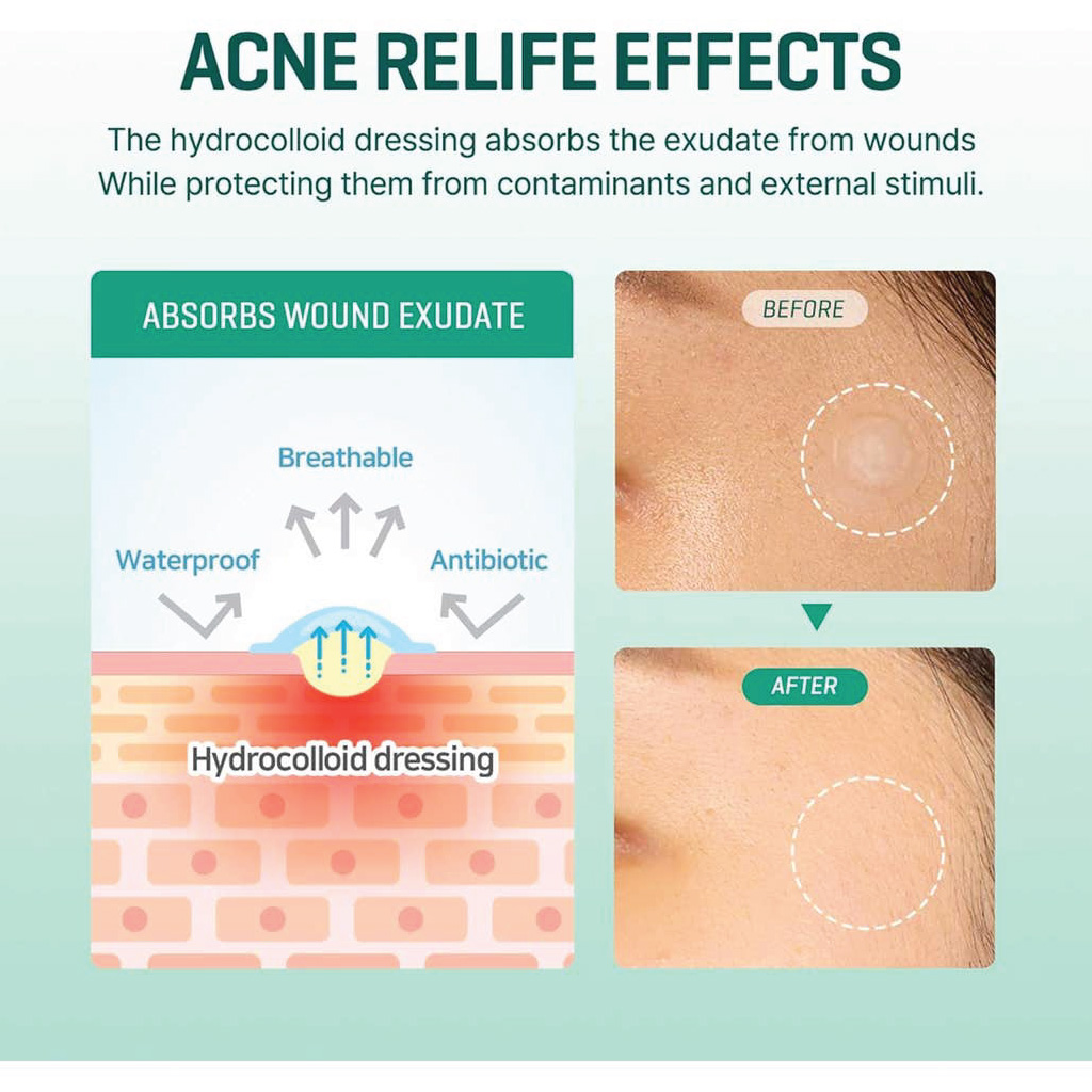 Some By Mi, 30 Days Miracle Clear Spot Patch, Acne spot treatment patches, 7ml (18 patches)