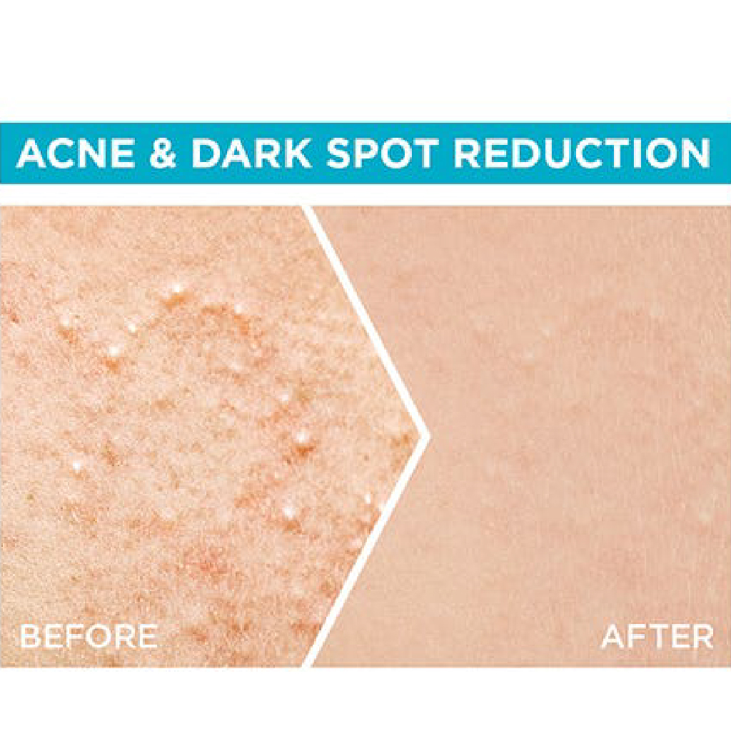 Garnier Anti Acne Serum Ba30 ml 002