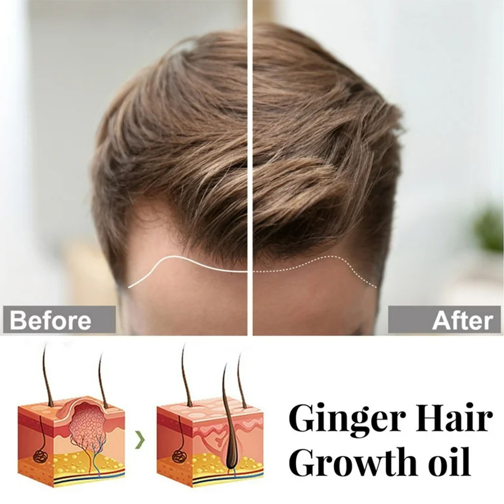 Hairgrow, 5% Minoxidil Topical Solution for Men, Hair Regrowth Treatment, 50ml
