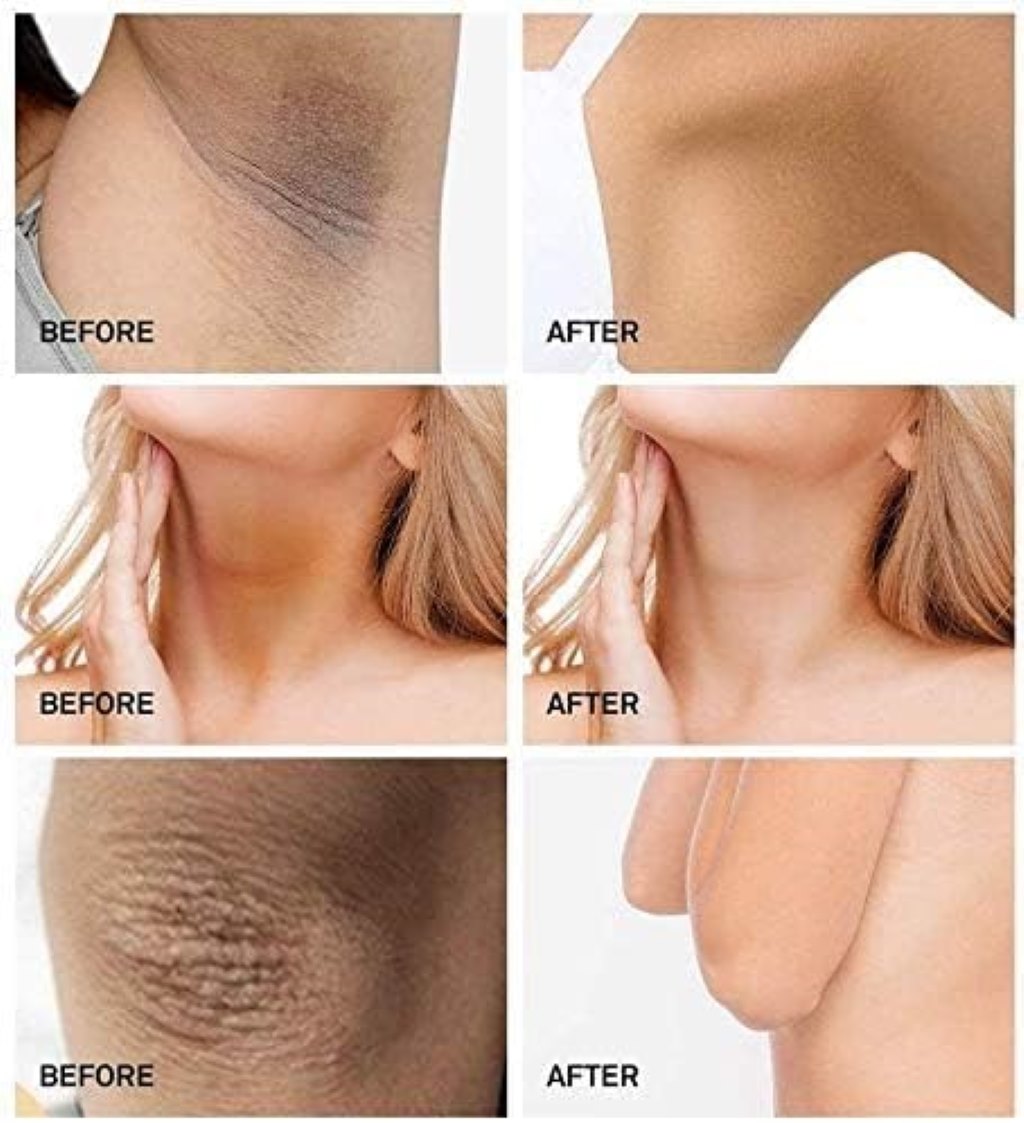 Pigmanorm, Cream for Skin Pigmentation, Skin lightening cream for pigmentation treatment, 30 g