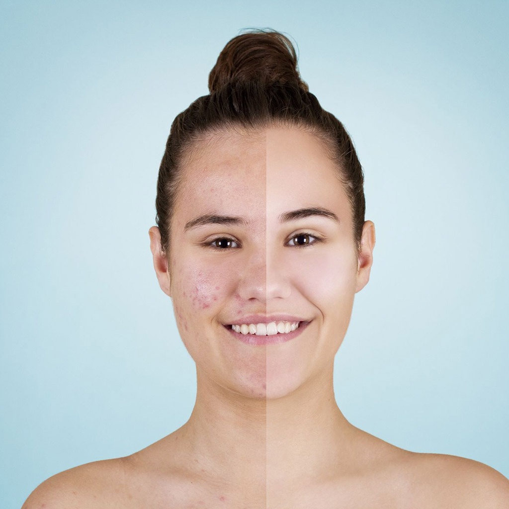 Differin 0.1% Adapalene Cream For Acne 30g