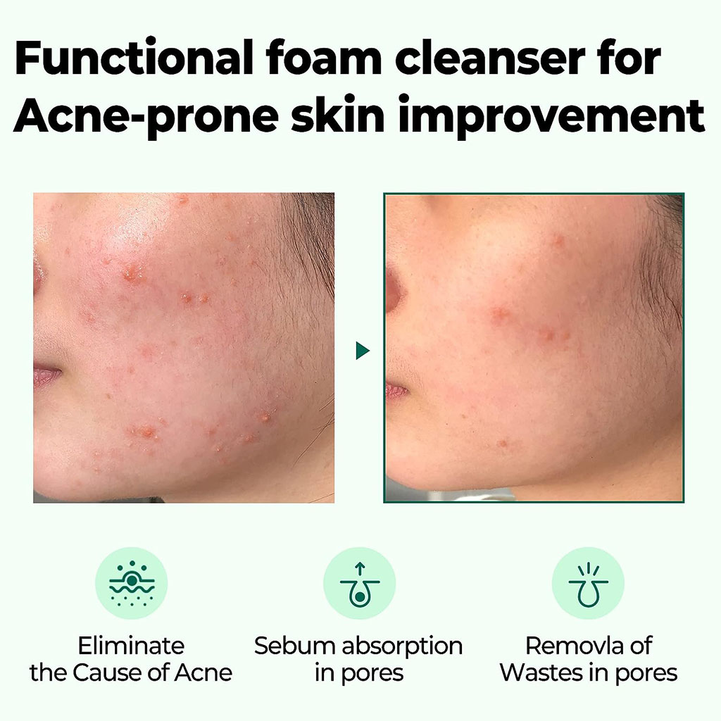 Sbm Aha-Bha-Pha 30Days Miracle Acne Clear Foam 100 ml