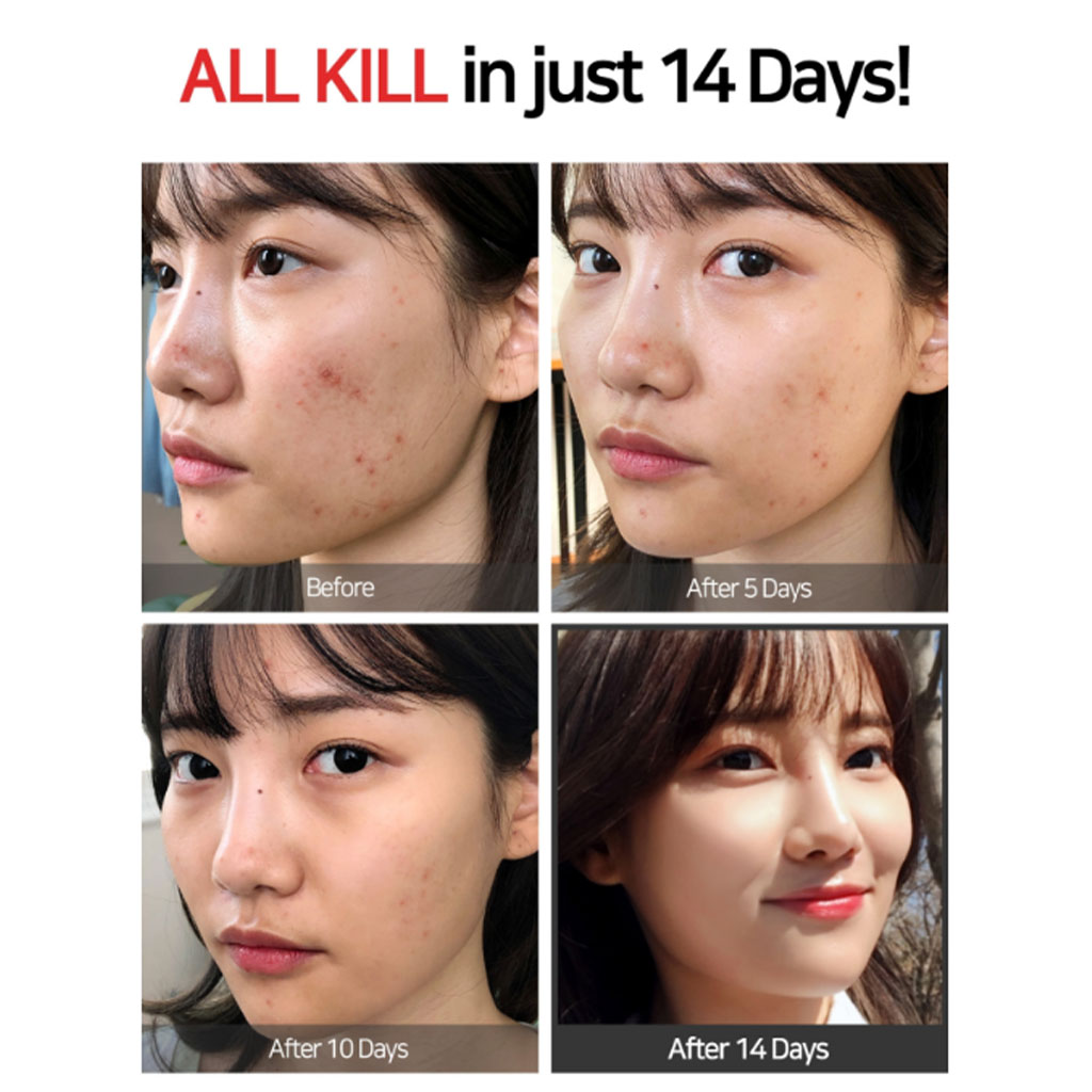 SBM, Super Miracle Spot All Kill Cream, Fast-acting cream for acne treatment, 30 ml